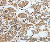 Immunohistochemistry of paraffin-embedded Human breast cancer using ASAH1 Polyclonal Antibody at dilution of 1:40