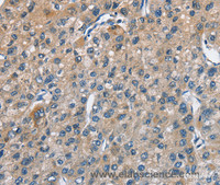 Immunohistochemistry of paraffin-embedded Human liver cancer using TRIP4 Polyclonal Antibody at dilution of 1:50