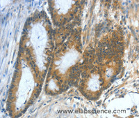 Immunohistochemistry of paraffin-embedded Human colon cancer using ASNS Polyclonal Antibody at dilution of 1:50