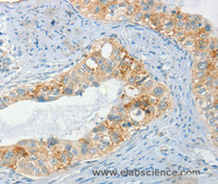 Immunohistochemistry of paraffin-embedded Human cervical cancer tissue using AANAT Polyclonal Antibody at dilution 1:40