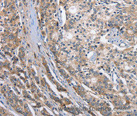 Immunohistochemistry of paraffin-embedded Human prostate cancer tissue using ABI3BP Polyclonal Antibody at dilution 1:50