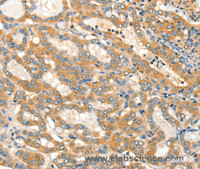 Immunohistochemistry of paraffin-embedded Human thyroid cancer tissue using ADCY3 Polyclonal Antibody at dilution 1:30