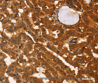 Immunohistochemistry of paraffin-embedded Human thyroid cancer tissue using IKZF3 Polyclonal Antibody at dilution 1:60