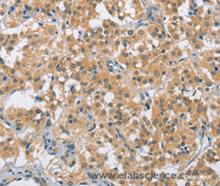 Immunohistochemistry of paraffin-embedded Human thyroid cancer using BCL10 Polyclonal Antibody at dilution of 1:40