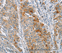 Immunohistochemistry of paraffin-embedded Human gastric cancer using BCL10 Polyclonal Antibody at dilution of 1:40