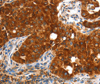 Immunohistochemistry of paraffin-embedded Human lung cancer using VWA5A Polyclonal Antibody at dilution of 1:60