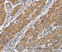 Immunohistochemistry of paraffin-embedded Human gastric cancer using COPB1 Polyclonal Antibody at dilution of 1:50