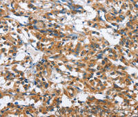 Immunohistochemistry of paraffin-embedded Human thyroid cancer tissue using BPI Polyclonal Antibody at dilution 1:50
