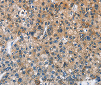 Immunohistochemistry of paraffin-embedded Human liver cancer tissue using BPI Polyclonal Antibody at dilution 1:50