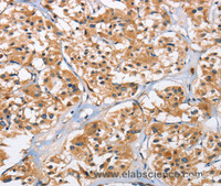 Immunohistochemistry of paraffin-embedded Human thyroid cancer tissue using EIF4EBP2 Polyclonal Antibody at dilution 1:40