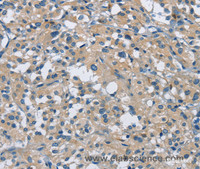 Immunohistochemistry of paraffin-embedded Human thyroid cancer using CAB39L Polyclonal Antibody at dilution of 1:30