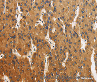 Immunohistochemistry of paraffin-embedded Human liver cancer using CALU Polyclonal Antibody at dilution of 1:40