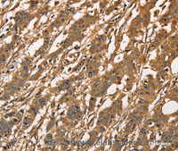 Immunohistochemistry of paraffin-embedded Human gasrtic cancer tissue using CAPZA3 Polyclonal Antibody at dilution 1:40