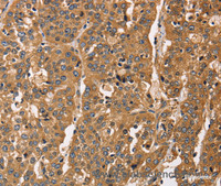 Immunohistochemistry of paraffin-embedded Human esophagus cancer tissue using CAPZA3 Polyclonal Antibody at dilution 1:40