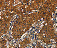 Immunohistochemistry of paraffin-embedded Human gastric cancer tissue using CATSPER4 Polyclonal Antibody at dilution 1:50