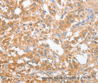 Immunohistochemistry of paraffin-embedded Human thyroid cancer tissue using OX2R Polyclonal Antibody at dilution 1:60