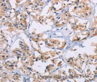 Immunohistochemistry of paraffin-embedded Human thyroid cancer tissue using NCR3 Polyclonal Antibody at dilution 1:40