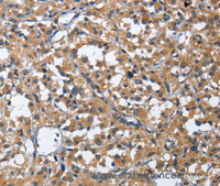 Immunohistochemistry of paraffin-embedded Human thyroid cancer using HSF27 Polyclonal Antibody at dilution of 1:40