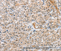 Immunohistochemistry of paraffin-embedded Human esophagus cancer tissue using CENPC Polyclonal Antibody at dilution 1:70