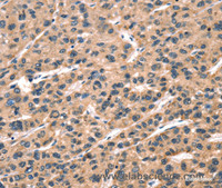 Immunohistochemistry of paraffin-embedded Human liver cancer tissue using hCG Polyclonal Antibody at dilution 1:65