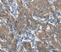 Immunohistochemistry of paraffin-embedded Human gastic cancer using CHMP1A Polyclonal Antibody at dilution of 1:60