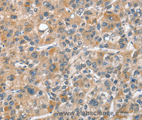 Immunohistochemistry of paraffin-embedded Human liver cancer tissue using CHMP4B Polyclonal Antibody at dilution 1:40