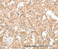 Immunohistochemistry of paraffin-embedded Human thyroid cancer using CIAPIN1 Polyclonal Antibody at dilution of 1:60