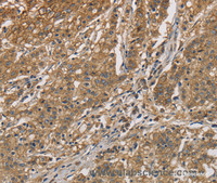 Immunohistochemistry of paraffin-embedded Human gastic cancer using CKMT2 Polyclonal Antibody at dilution of 1:60