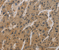 Immunohistochemistry of paraffin-embedded Human liver cancer using CORO1C Polyclonal Antibody at dilution of 1:50