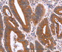 Immunohistochemistry of paraffin-embedded Human colon cancer tissue using CRISP3 Polyclonal Antibody at dilution 1:40