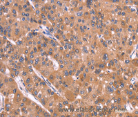 Immunohistochemistry of paraffin-embedded Human liver cancer tissue using CRISP3 Polyclonal Antibody at dilution 1:40