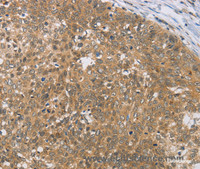 Immunohistochemistry of paraffin-embedded Human cervical cancer tissue using DIO1 Polyclonal Antibody at dilution 1:50