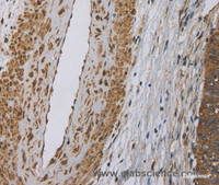 Immunohistochemistry of paraffin-embedded Human cervical cancer tissue using DCTN3 Polyclonal Antibody at dilution 1:50