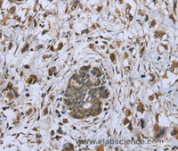 Immunohistochemistry of paraffin-embedded Human breast cancer tissue using DCTN4 Polyclonal Antibody at dilution 1:30