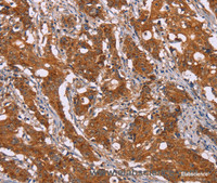 Immunohistochemistry of paraffin-embedded Human gasrtic cancer tissue using DCTN6 Polyclonal Antibody at dilution 1:40