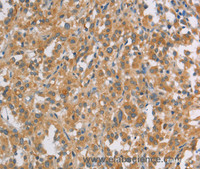 Immunohistochemistry of paraffin-embedded Human thyroid cancer using DDX53 Polyclonal Antibody at dilution of 1:40