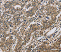 Immunohistochemistry of paraffin-embedded Human gastic cancer using DHRS3 Polyclonal Antibody at dilution of 1:30