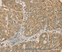 Immunohistochemistry of paraffin-embedded Human ovarian cancer using DMRT3 Polyclonal Antibody at dilution of 1:50