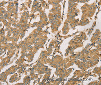 Immunohistochemistry of paraffin-embedded Human breast cancer using DMRT3 Polyclonal Antibody at dilution of 1:50