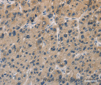 Immunohistochemistry of paraffin-embedded Human liver cancer tissue using DUSP26 Polyclonal Antibody at dilution 1:50