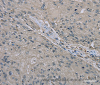 Immunohistochemistry of paraffin-embedded Human esophagus cancer tissue using EDN1 Polyclonal Antibody at dilution 1:30