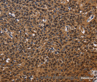 Immunohistochemistry of paraffin-embedded Human cervical cancer tissue using EXTL3 Polyclonal Antibody at dilution 1:50