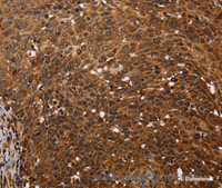 Immunohistochemistry of paraffin-embedded Human cervical cancer tissue using FANCF Polyclonal Antibody at dilution 1:60