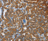 Immunohistochemistry of paraffin-embedded Human thyroid cancer tissue using FLCN Polyclonal Antibody at dilution 1:40