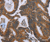 Immunohistochemistry of paraffin-embedded Human colon cancer using GH2 Polyclonal Antibody at dilution of 1:60