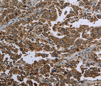 Immunohistochemistry of paraffin-embedded Human liver cancer using HSPA9 Polyclonal Antibody at dilution of 1:50