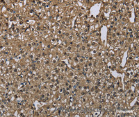 Immunohistochemistry of paraffin-embedded Human prostate cancer using GSTA3 Polyclonal Antibody at dilution of 1:30