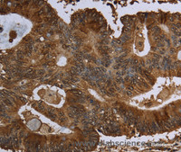 Immunohistochemistry of paraffin-embedded Human colon cancer tissue using HPGD Polyclonal Antibody at dilution 1:30