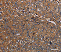 Immunohistochemistry of paraffin-embedded Human renal cancer tissue using HYAL2 Polyclonal Antibody at dilution 1:40