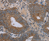 Immunohistochemistry of paraffin-embedded Human colon cancer tissue using IFRD1 Polyclonal Antibody at dilution 1:30